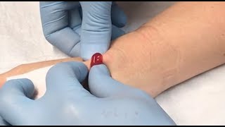 ganglion cyst drainage [upl. by Kcoj]