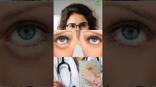 Enlever les cernes sous les yeux cernes recettefacile santé [upl. by Enyehc]