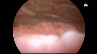 Cystitis cystica Cystoscopy findings [upl. by Bui796]