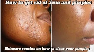 QUICK PIMPLE SOLUTION  GET RID OF ACNE  clean and clear blackhead clearing cleanser review [upl. by Fleck]