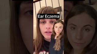 Facts About Ear Eczema Explained [upl. by Ekalb]