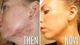 HOW I CONTROL MY ACNE  Skincare Favorites for Cystic AcneOily SkinAging amp Melasma [upl. by Noma]