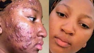 How to  remove pimples  pimples holes  darkspots created by pimples hyperpigmentation latest2021 [upl. by Ardnaik]