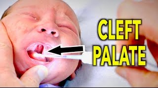 CLEFT PALATE Newborn  Dr Paul [upl. by Clarabelle331]