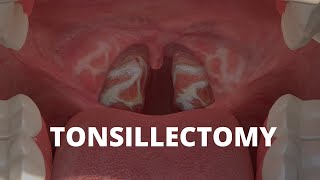 What is Tonsillectomy [upl. by Prevot]