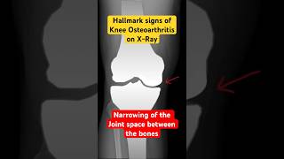 Joint space narrowing on Xray of knee with Osteoarthritis health radiology kneepain [upl. by Dora]