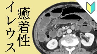 【おきらく版】第１５回：癒着性イレウス 癒着による腸閉塞（イレウス）のCT画像 [upl. by Saville642]