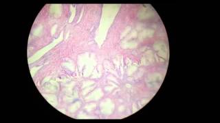 Benign prostatic hyperplasia histopathology [upl. by Karoly]