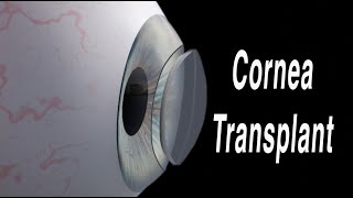 Cornea Transplant Penetrating Keratoplasty [upl. by Alletsyrc]