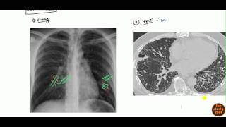 Bronchiectasis for USMLE [upl. by Mide952]