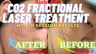 My 4th Session Before and After Results Co2 Fractional Laser Acne Scar Treatment in Cebu Philippines [upl. by Arleyne]