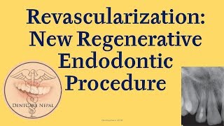 Revascularization  Regenerative Endodontic Procedure [upl. by Agnola969]