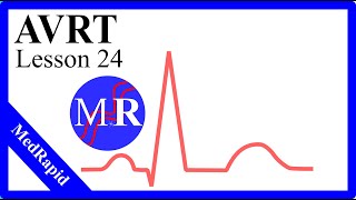 Atrioventricular Reentrant Tachycardia AVRT [upl. by Yrrep]