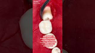 Extraction of third molar foryou teethwhitening video [upl. by Koser]