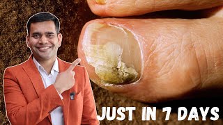 Just in 7 Days Cure Toenail Fungus At Home  Best Remedy For Toenail Fungus  Dr Vivek Joshi [upl. by Buckie]