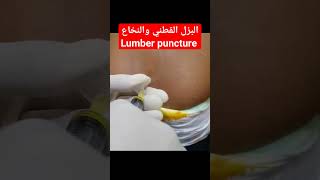 طريقة البزل القطني والنخاع lumbar puncture shorts [upl. by Camilia56]