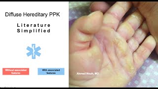 A Clinical approach to Palmoplantar Keratoderma [upl. by Narcho847]