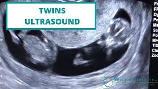 TAKE A PEEK Twins at 11 Weeks [upl. by Sonja279]