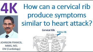 How can a cervical rib produce symptoms similar to heart attack [upl. by Limber]