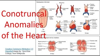 Conotruncal anomalies of the heart [upl. by Eamon515]