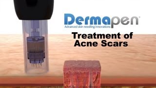 MicroNeedling for Acne Scars  Dermapen® Treatment [upl. by Adnalahs594]