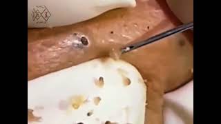 Satisfying Blackheads Removal satisfying viral trending respect pimplepoping [upl. by Fisk]