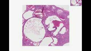 Histopathology KidneyAdult polycystic disease [upl. by Malony]