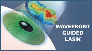 Unlocking the Power of LASIK with Wavefront Technology [upl. by Belcher]