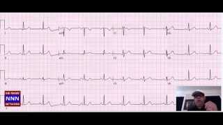 Rapid EKG interpretation for Doctors Nurses and Students NIK NIKAM MD [upl. by Guerin]