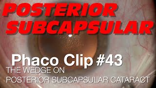 Phaco Clip 43  The WEDGE on Posterior Subcapsular Cataract [upl. by Rehm]