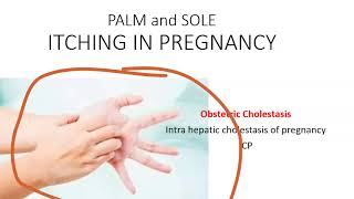 Obstetrics Cholestasis Pregnancy IntraHepatic Liver ICP Itching Palm pregnant Bile Acid Ursodiol [upl. by Jain421]