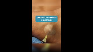 Watch this ganglion cyst get drained ganglioncyst podiatrist [upl. by Iharas]