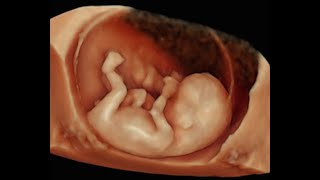 How to Perform 3D Scan of the Baby at 12 Weeks of Pregnancy [upl. by Hras247]