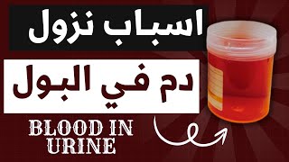 27اسباب نزول الدم في البول Hematuria amp Hemoglobinuria وتفسير العلاقة بين الدم والشريط والميكروسكوب [upl. by Yrehc]