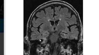 MRI in Epilepsy [upl. by Andri]