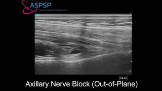 Ultrasound Guided Axillary Nerve Block Out of Plane Approach [upl. by Saihtam]