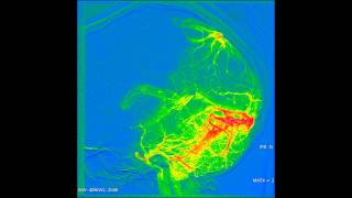 Angiography of the brain [upl. by Yenor]