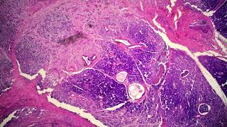 Mucoepidermoid Carcinoma High Grade [upl. by Oakes691]