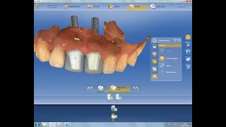 Implantodontia Conteporânea Cap 7 caso 5  TiBases C para Implante Helix GM [upl. by Tamar]