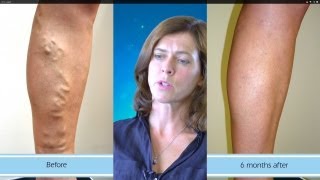 Amazing Results from Varicose Vein Surgery [upl. by Lletniuq]