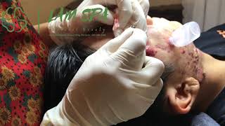 Treatment of acne pustules severe inflammation  Điều trị mụn mủ viêm nặng  LAMSPA PHU QUOC  L P1 [upl. by Alegnaoj124]