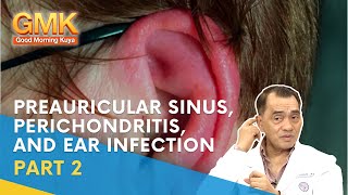 Preauricular Sinus Perichondritis and Ear Infection Part 2  Usapang Pangkalusugan [upl. by Timothy574]