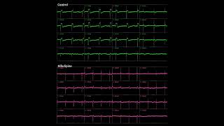 Cardiotoxicity Study Results [upl. by Beker746]