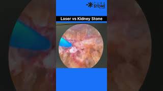 Kidney stone Treatment using Laser RIRS  Curestone  Gurgaon  Retrograde intrarenal surgery [upl. by Bobina]