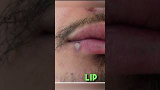 Behind these common skin lesions clinical Skin [upl. by August]