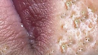 Big Cystic Acne Blackheads Extraction Blackheads amp Milia Whiteheads Removal Pimple Popping  2738 [upl. by Aloeda983]