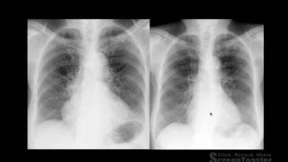 Thorax  Semiologia Radiológica do Tórax  PARTE 1 [upl. by Fisher]