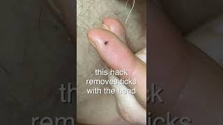 Ticks Trick Removal  Zecken entfernen Hack  fast secure amp cheap [upl. by Nevile977]