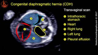 Fetal echocardiography at 1113 weeks Congenital Diaphragmatic Hernia CDH [upl. by Currier]