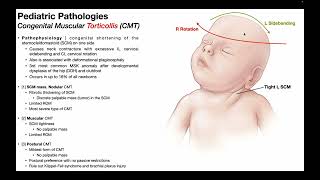 Torticollis → Mechanism Pathophysiology amp Effects in Infants [upl. by Sandry]